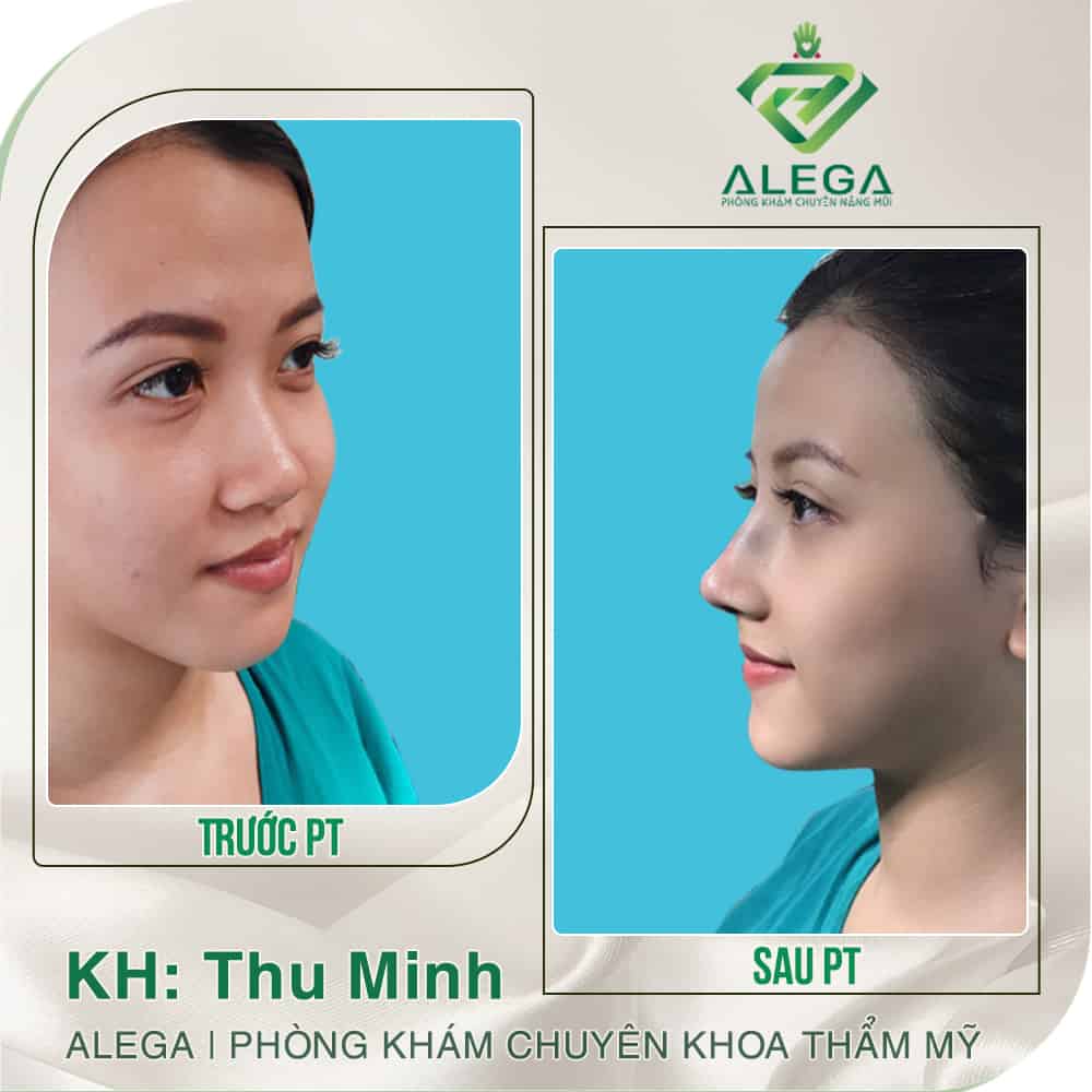 HINH ANH TRUOC SAU 2