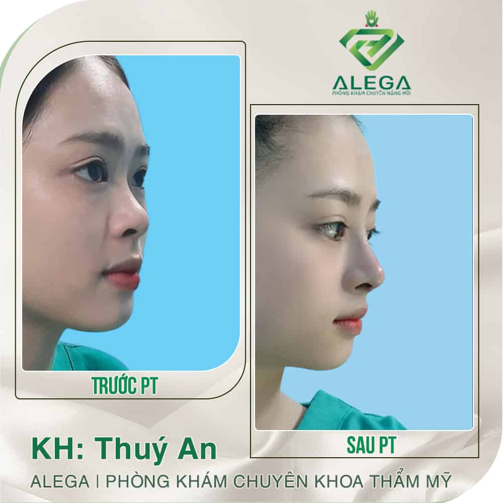 HINH ANH TRUOC SAU 3