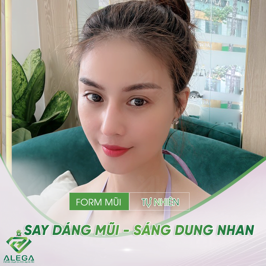 Nâng mũi Hàn Quốc 3 NC5 1