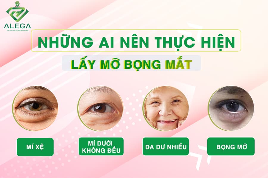 Nhung ai nen thuc hien lay mo bong mat