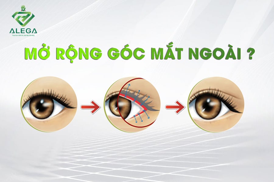 mO RONG GOC MAT NGOAI