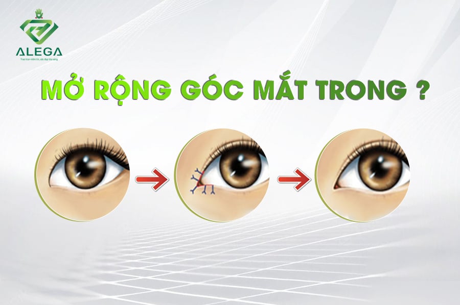 mO RONG GOC MAT TRONG